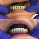 Apatinių dantų protezavimas