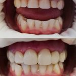 Šoninių dantų protezavimas, priekinių estetinis plombavimas